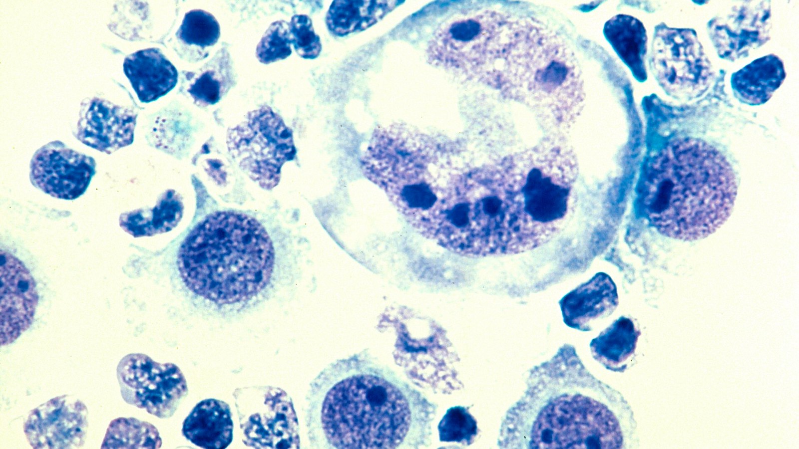 Lymphome : un essai de phase 3 renforce les données sur l’epcoritamab en première ligne